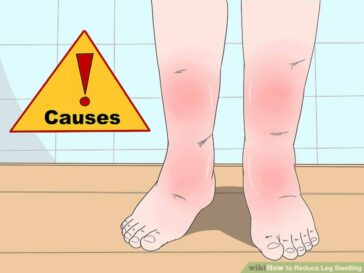 pictures of swollen ankles due to kidney problems pictures of swollen ankles due to kidney problems